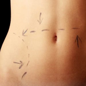 A person having more than one cosmetic surgery procedure at the same time