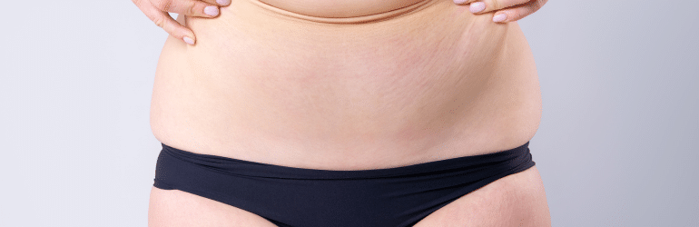 Tummy Tuck Recovery What to Expect