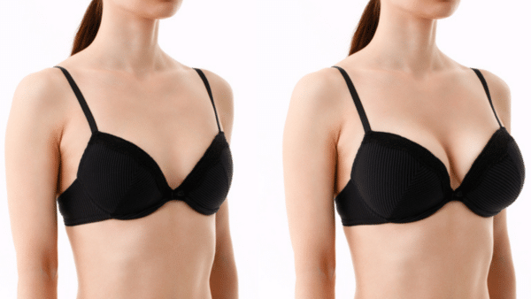 Breast Lift Surgery: What You Need to Know